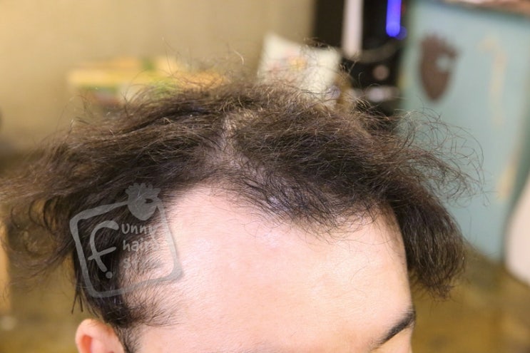  남자 탈모 앞머리 갈라짐 테이프 붙임머리 증모술