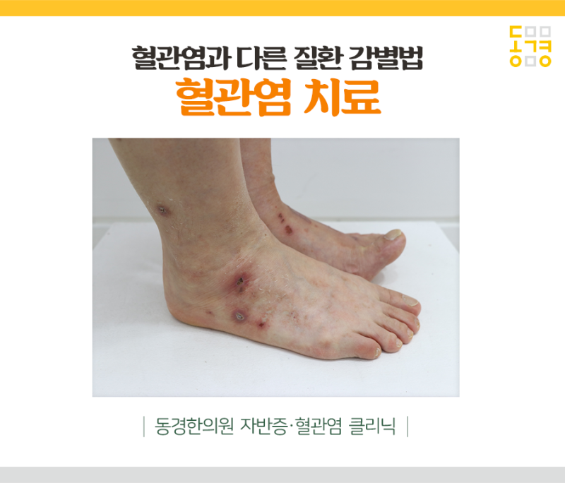 부산혈관염치료 장기를 손상시키는 혈관염