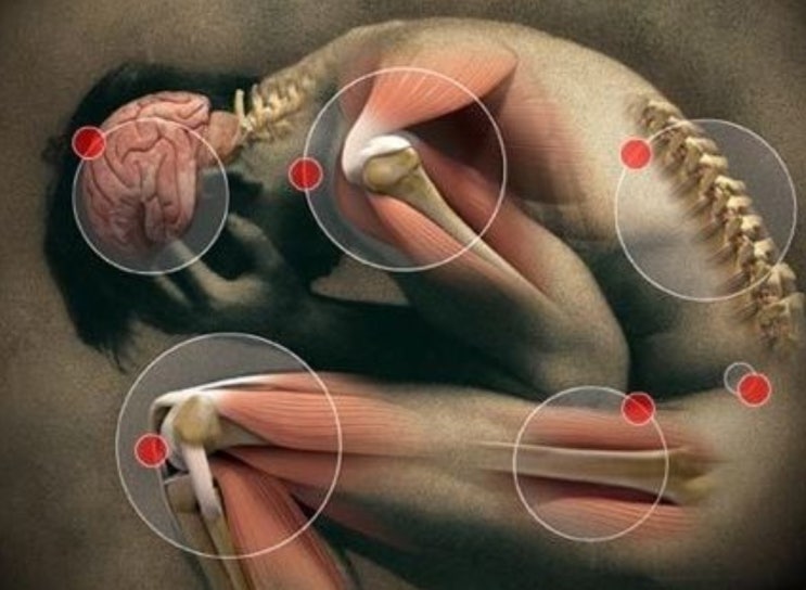 복합부위통증증후군(CRPS)에 의한 이질통의 한약치료 증례보고