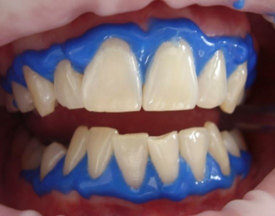 치과 마다 치아미백 비용이 다른 이유가 있나요?