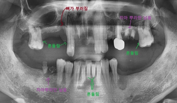  이가 빠졌어요. 이 빠진 환자 보철 환자 케이스 소개 <시청역 연세예감치과>