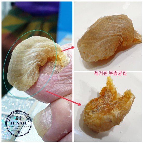 할아버지의 두꺼운발톱(손발톱굽음증,조갑구만증,Onychogryphosis)때문에 깍을수가 없어요./분당용인수원수지보정동백죽전동/주네일/무좀파고드는발톱전문네일샵