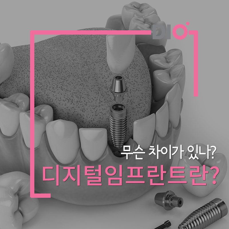 디지털 임플란트의 차이점 비교