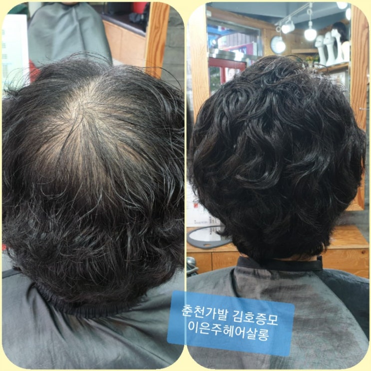  춘천가발 김호증모 여성탈모 부분가발 탑피스로 자신감 찾기~