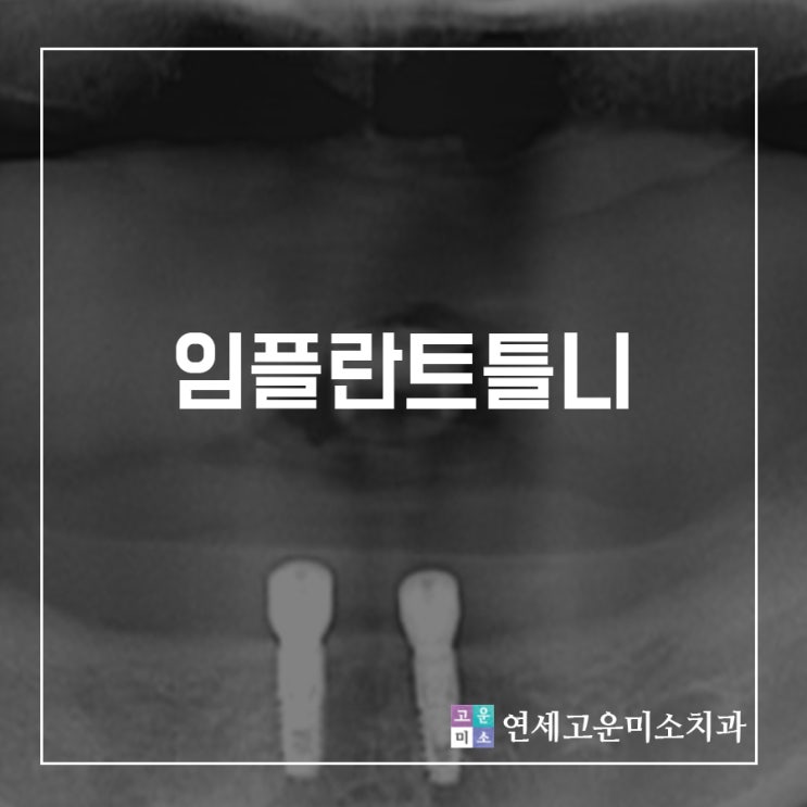  임플란트틀니, 개수는 적지만 신중하게