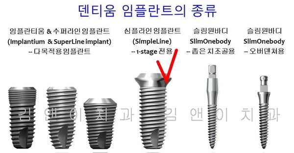 덴티움 임플란트로 치료한 어금니 임플란트 사례 : 네이버 블로그 덴티움 임플란트로 치료한 어금니 임플란트 사례 : 네이버 블로그