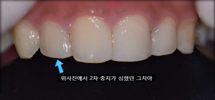  레진치료가 먼가요?