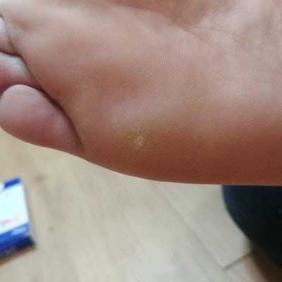 [사진 주의] 족저사마귀 치료 후기, 율무가루, 냉동치료, 티눈밴드 종합 치료