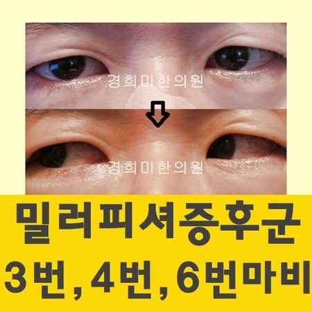 [상계역 경희미한의원] 밀러피셔증후군, 길랑바레증후군(길랭바레증후군)의 복시현상, 복시....
