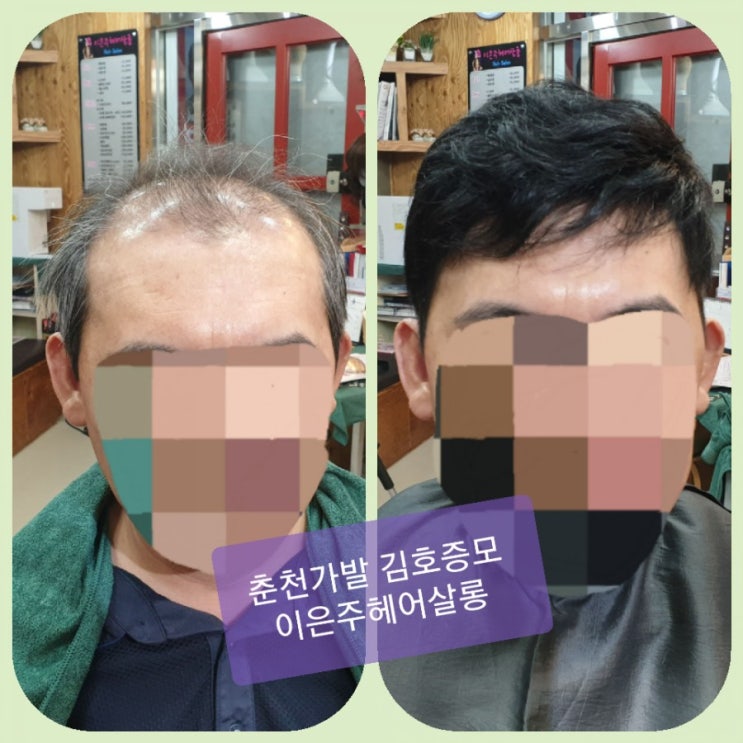  춘천가발 김호증모 벨크로반전두가발 편하고 좋네요 하나 더 본뜨고 매월 관리 해 주세요~^^