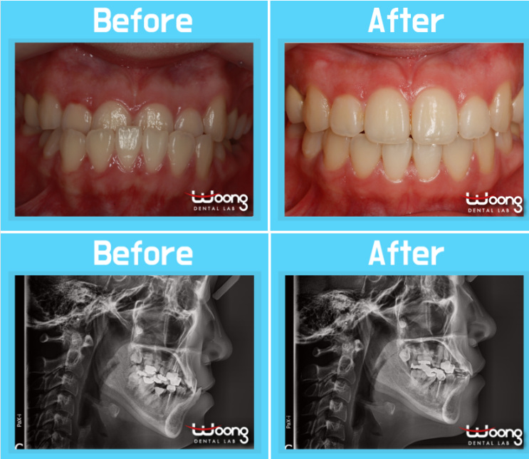 압구정치아교정 사랑니를 어금니로 대체하다