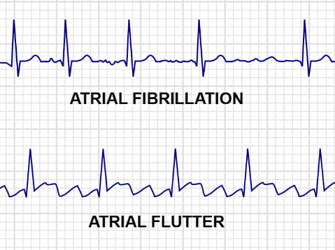 심방조동 (Atrial Flutter) : 네이버 블로그