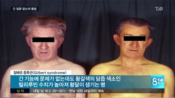  알베르증후군