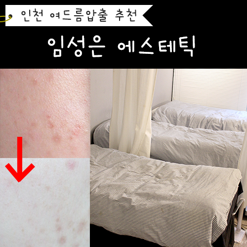  인천성인여드름 임성은 에스테틱 압출 진작에 올껄!