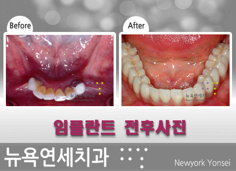 치아가 없을때 꼭 임플란트 시술을 치료를 해야 하나요?