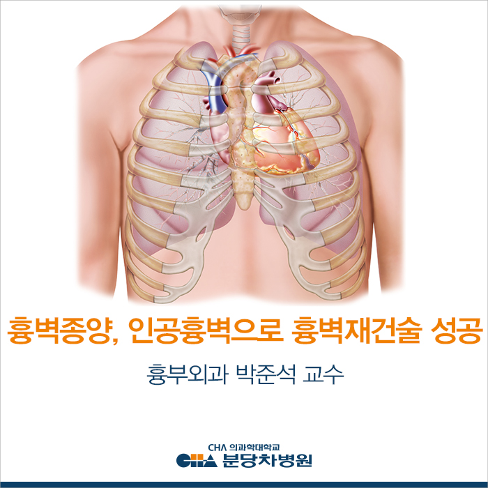  흉벽종양, 인공흉벽 개발로 흉벽재건수술 성공_분당 차병원 흉부외과 박준석 교수