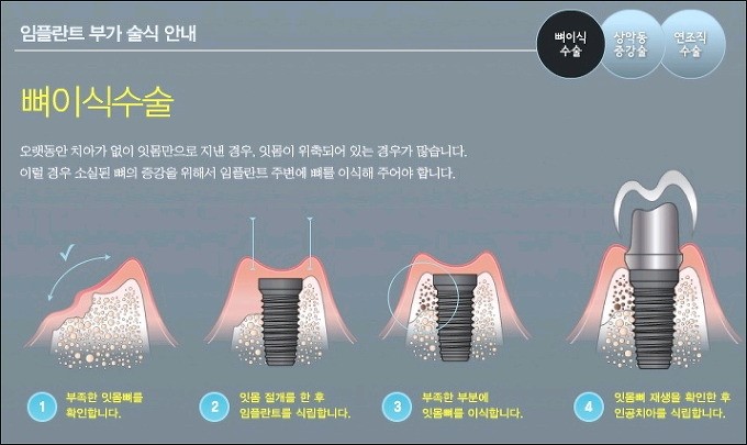  [세종시치과,세종시임플란트]만 65세 이상 보험임플란트 는 종촌동 우리치과에서