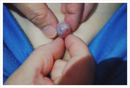 남아 생식기 관리&세척&귀두포피염 예방과 치료 비법 : 네이버 블로그