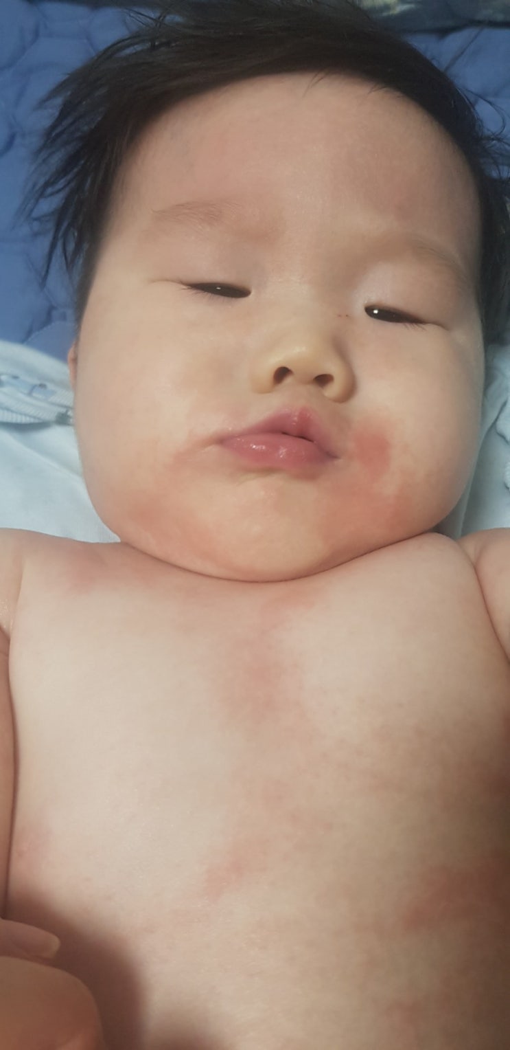  서울대 어린이병원/소아피부과/김규한교수님/아토피진단/7개월아기 첫니!