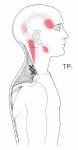 뒷골이 땡기는 이유 -긴장성 두통과 그 외의 원인들