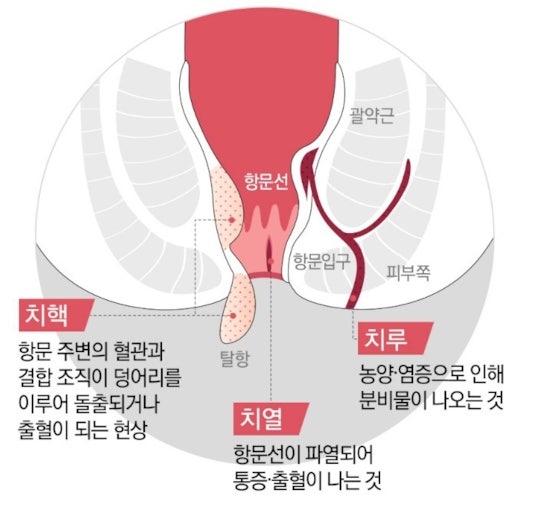 4기 치질 수술 후기 ( 치질 관리,치질 증상, 치질병원) : 네이버 블로그