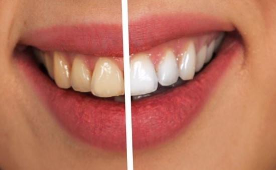 보철 치료 후 치아미백 치료가 가능한가요?