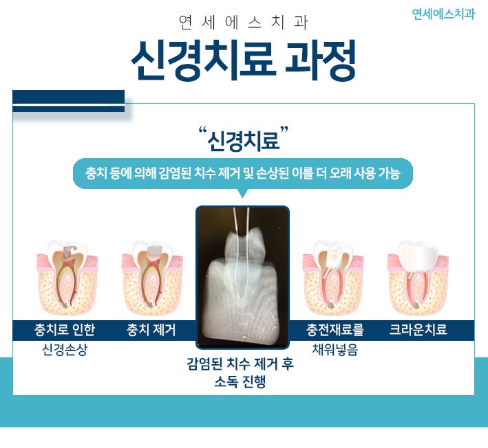 분당 치과신경치료 후 크라운 필수