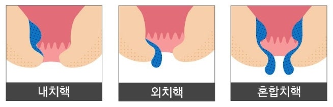 4기 치질 수술 후기 ( 치질 관리,치질 증상, 치질병원) : 네이버 블로그