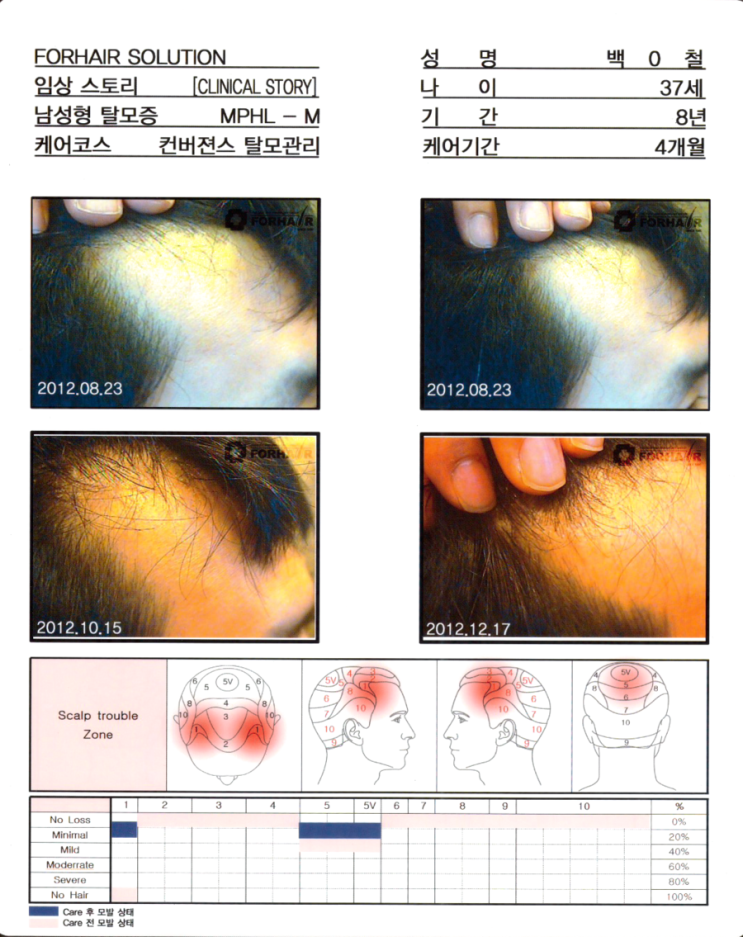 탈모기간 8년,37세의 여성,케어기간 4개월후 모발증가 사진.강서구 탈모 강서 탈모 관리 전후 사진. 두피 건선 각질 관리 닥터포헤어 가양역점. 탈모기간 8년,37세의 여성,케어기간 4개월후 모발증가 사진.강서구 탈모 강서 탈모 관리 전후 사진. 두피 건선 각질 관리 닥터포헤어 가양역점.