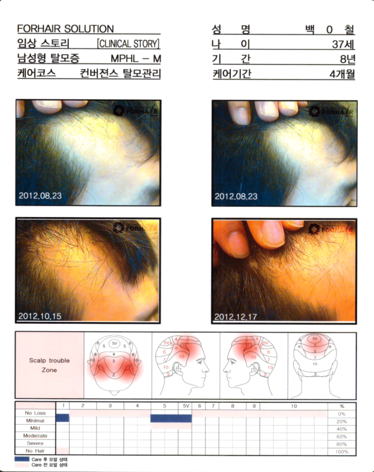 탈모기간 8년,37세의 여성,케어기간 4개월후 모발증가 사진.강서구 탈모 강서 탈모 관리 전후 사진. 두피 건선 각질 관리 닥터포헤어 가양역점.