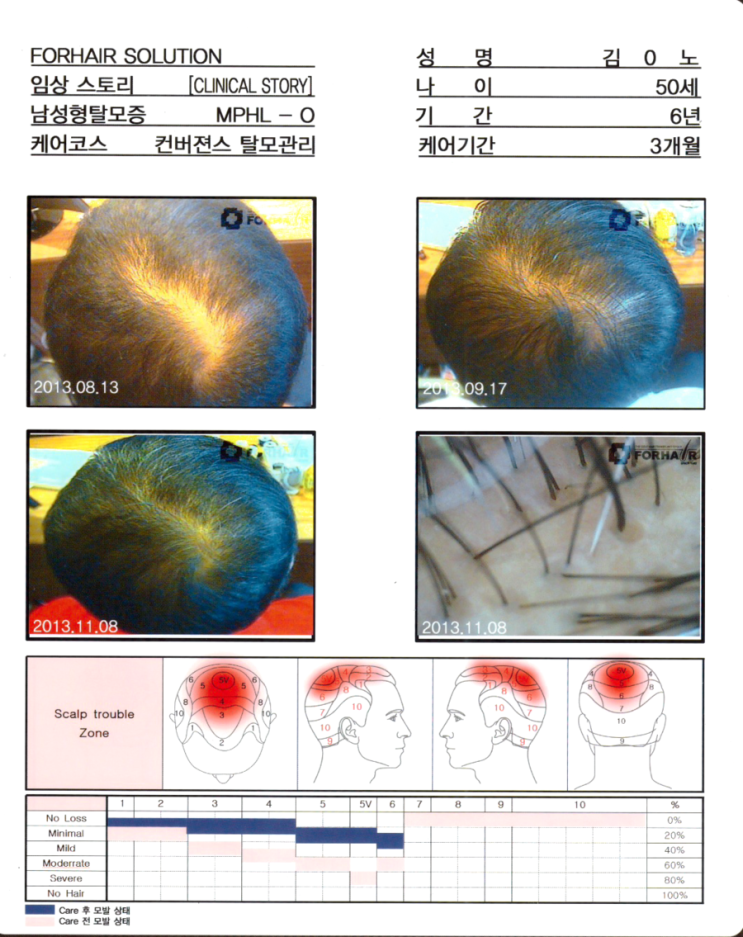 탈모기간 6년,50세의 남성, 케어기간 3개월 후 모발 증가사진입니다. 발산역 발산동 탈모 두피 건선 각질 관리 