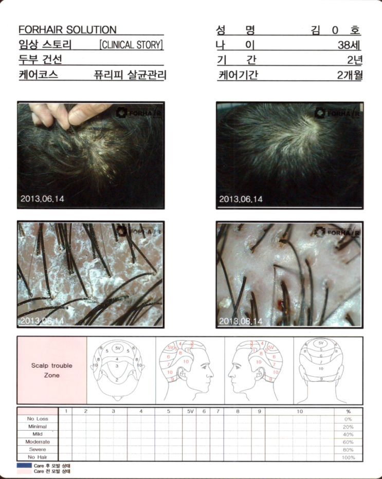 탈모기간 2년,38세의 남성, 퓨리피 살균관리 2개월 후 모발증가 사진.상암역 상암 탈모 두피 건선 각질 관리 