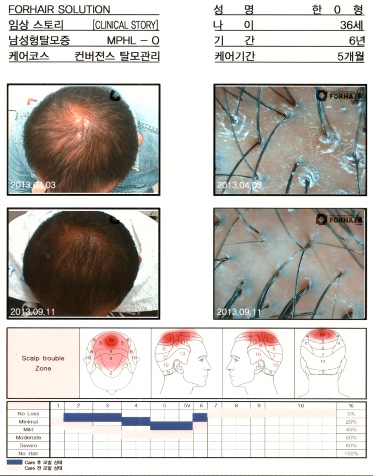 탈모기간 6개월,36세의남성,0형탈모,5개월간의 관리후 모발증가 사진,화곡 탈모 원형 탈모 전후 사진, 닥터포헤어 가양역점. 화곡역 탈모 두피 건선 각질 관리 화곡동 탈모 탈모기간 6개월,36세의남성,0형탈모,5개월간의 관리후 모발증가 사진,화곡 탈모 원형 탈모 전후 사진, 닥터포헤어 가양역점. 화곡역 탈모 두피 건선 각질 관리 화곡동 탈모
