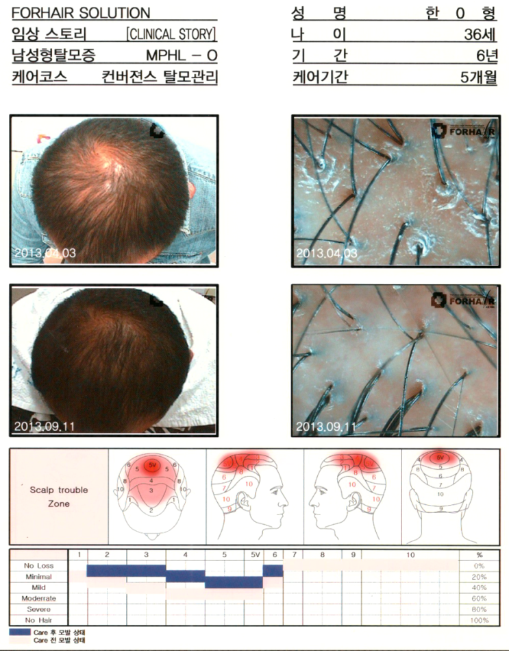 탈모기간 6개월,36세의남성,0형탈모,5개월간의 관리후 모발증가 사진,화곡 탈모 원형 탈모 전후 사진, 닥터포헤어 가양역점. 화곡역 탈모 두피 건선 각질 관리 화곡동 탈모