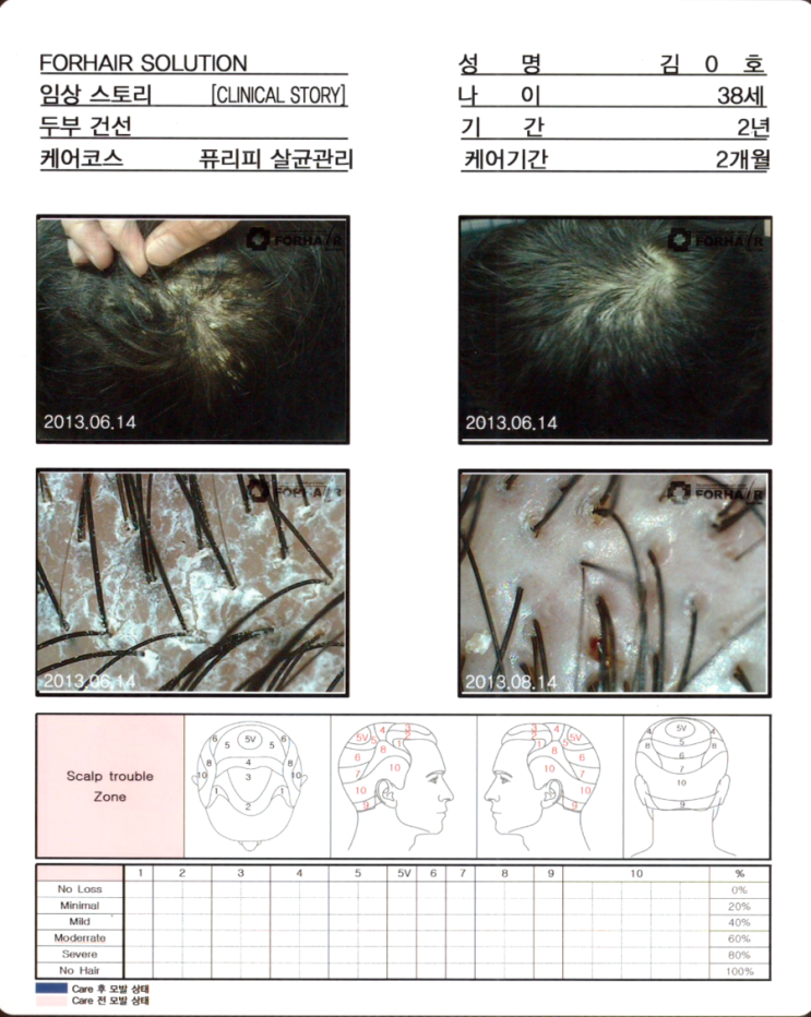 원형 탈모증의 원인과 치료방법,등촌 탈모,등촌역 탈모,등촌동 탈모,강서구 탈모,닥터포헤어 가양역점,두피탈모,남성탈모,여성탈모,원형탈모 원형 탈모증의 원인과 치료방법,등촌 탈모,등촌역 탈모,등촌동 탈모,강서구 탈모,닥터포헤어 가양역점,두피탈모,남성탈모,여성탈모,원형탈모