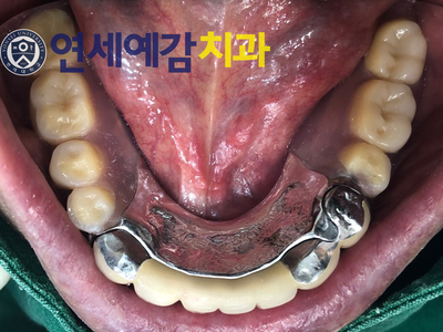  남대문시장&시청역가까운 치과/보험틀니 환자분 스토리 소개
