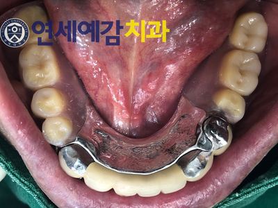 남대문시장&시청역가까운 치과/보험틀니 환자분 스토리 소개