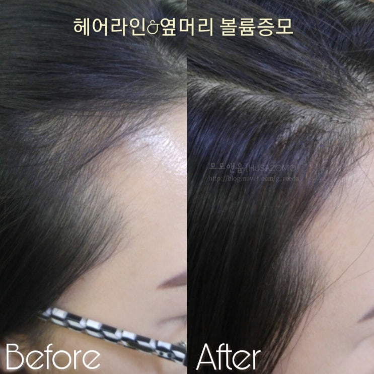  [모모앤윰 증모이야기] 20~30대 남녀들의 말 못할 고민..부분탈모!! 모모앤윰 증모술로 고민해결!!