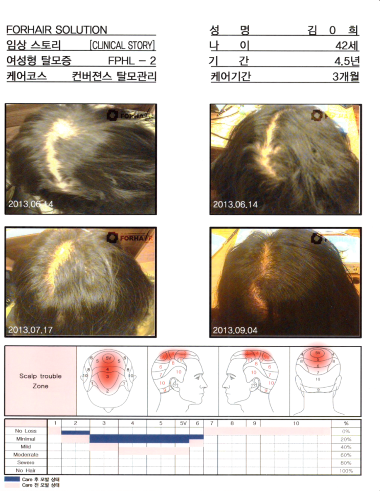 탈모기간 4.5년,42세의 여성,케어기간 3개월후 모발 증가 사진.등촌동 등촌역 남성형 O자형 관리 전후 사진. 등촌 탈모 두피 건선 각질 