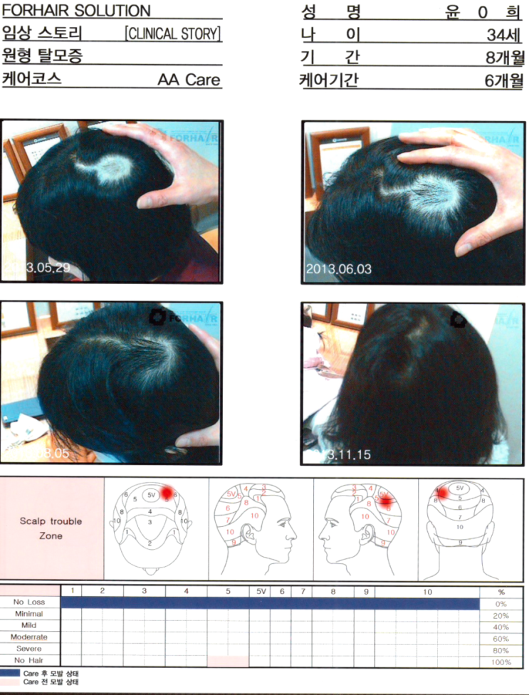 탈모기간 8개월,34세의 여성,케어기간 6개월 후 모발증가 사진,화곡동 남성 O자형 탈모 관리 전후 사진. 화곡 화곡역 탈모 두피 건선 각질 관리 