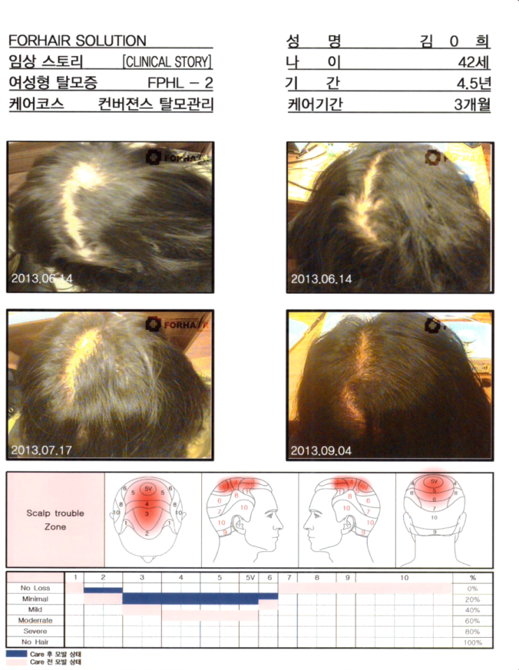 탈모 치료제 프로페시아,상암탈모,상암역탈모,상암동탈모,탈모,닥터포헤어,가양역점,탈모진단,탈모치료,탈모케어,탈모관리,남성탈모,여성탈모 탈모 치료제 프로페시아,상암탈모,상암역탈모,상암동탈모,탈모,닥터포헤어,가양역점,탈모진단,탈모치료,탈모케어,탈모관리,남성탈모,여성탈모