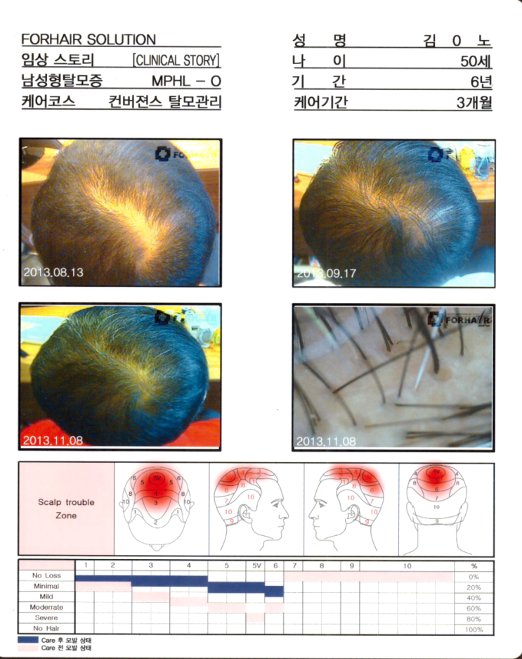 탈모 치료방법,발산탈모,탈모약,미녹시딜,미녹시딜5%,발산역탈모,발산동탈모,닥터포헤어,강서구탈모,두피,남성탈모,여성탈모,원형탈모,탈모진단 탈모 치료방법,발산탈모,탈모약,미녹시딜,미녹시딜5%,발산역탈모,발산동탈모,닥터포헤어,강서구탈모,두피,남성탈모,여성탈모,원형탈모,탈모진단
