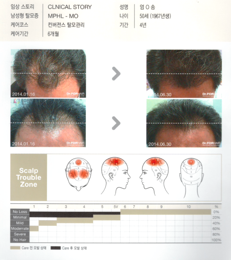 탈모기간 4년,컨버젼스 탈모관리 6개월 후 모발증가 사진입니다. 탈모기간 4년,컨버젼스 탈모관리 6개월 후 모발증가 사진입니다.