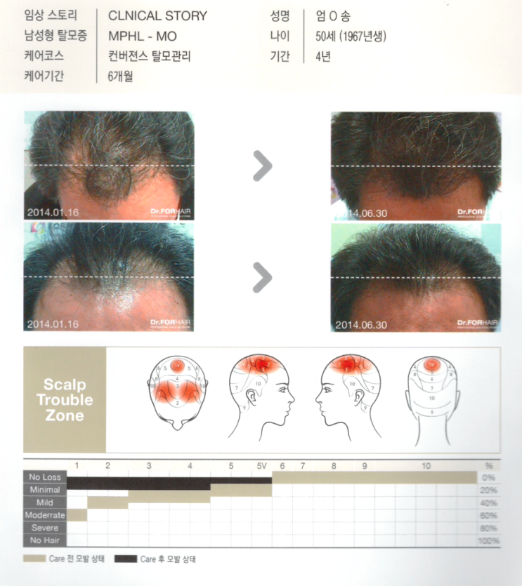 탈모기간 4년,컨버젼스 탈모관리 6개월 후 모발증가 사진입니다.