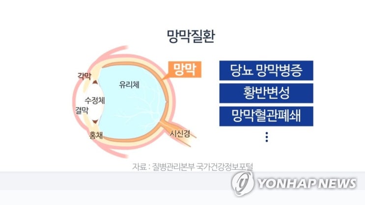  AI, 망막질환과 폐렴 진단한다
