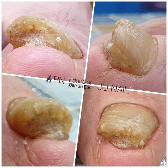 내성발톱 1년에한번씩 수술했어요./분당용인수원수지보정동백죽전동/주네일/무좀파고드는발톱전문네일샵 내성발톱 1년에한번씩 수술했어요./분당용인수원수지보정동백죽전동/주네일/무좀파고드는발톱전문네일샵