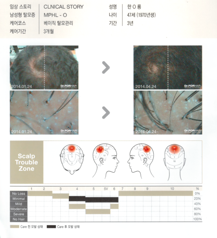 탈모기간 3년,베이직 탈모관리 3개월 후 모발증가 사진입니다. 탈모기간 3년,베이직 탈모관리 3개월 후 모발증가 사진입니다.
