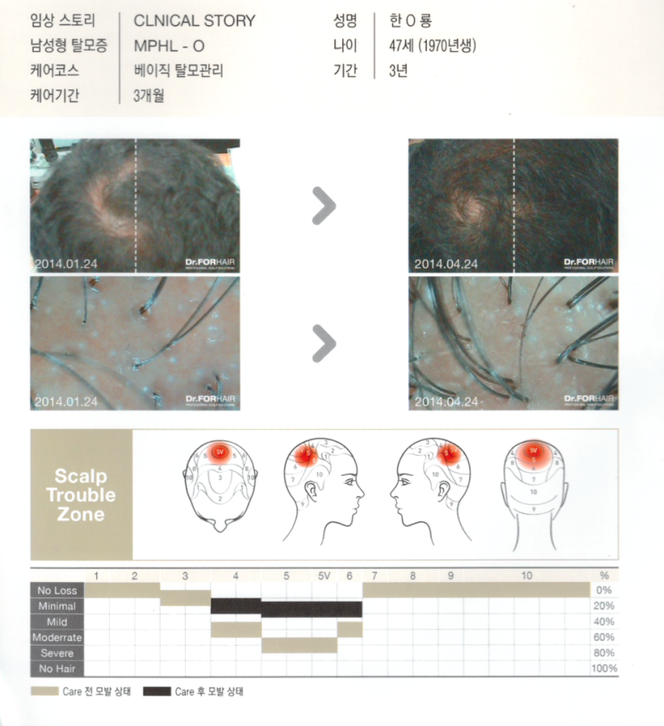 탈모기간 3년,베이직 탈모관리 3개월 후 모발증가 사진입니다.