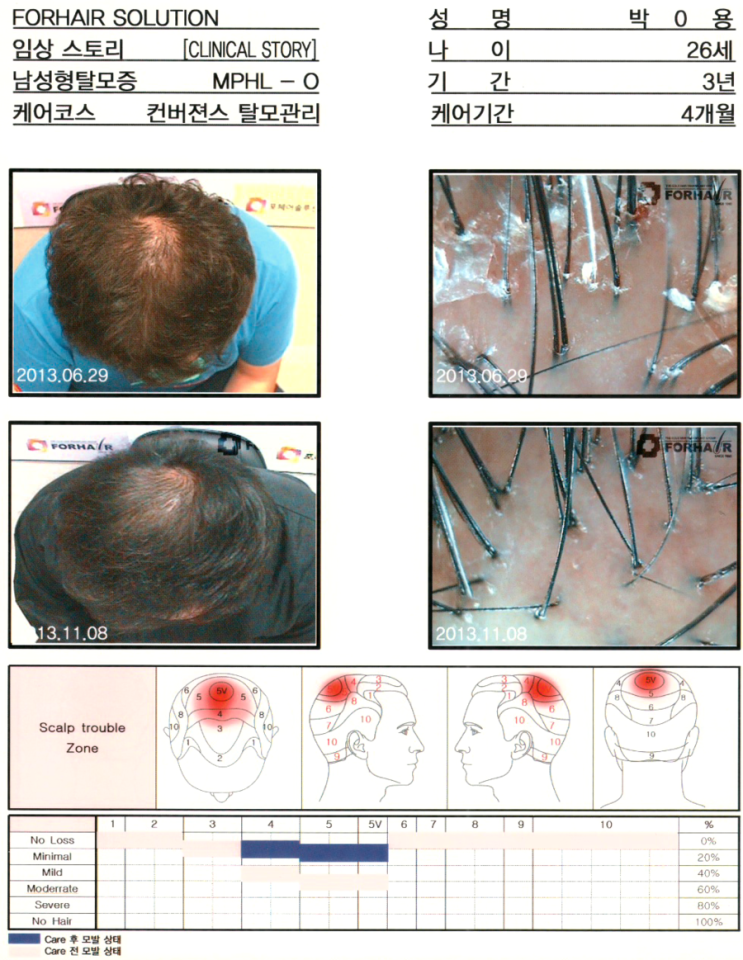 탈모기간 3년, 26세의 남성, O형 탈모, 4개월간의 관리 후, 모발 증가 사진입니다.두피유형 지성,가양동 탈모 관리 전후 사진. 탈모 두피 건선 각질관리 닥터포헤어 가양역점. 가양 가양역