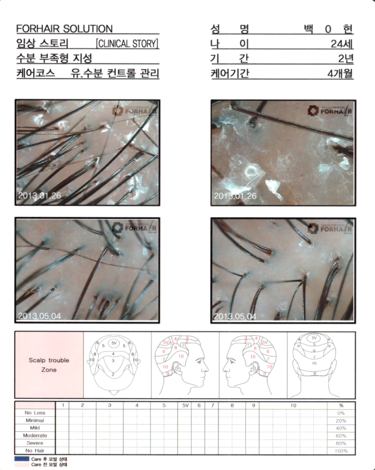 탈모기간 2년, 유,수분 컨트롤 관리 4개월 후 두피사진입니다. 탈모기간 2년, 유,수분 컨트롤 관리 4개월 후 두피사진입니다.
